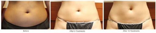 Study Confirms CORE Technology as Gold Standard for Body Contouring and Emphasizes Safe Treatments for All Skin Types