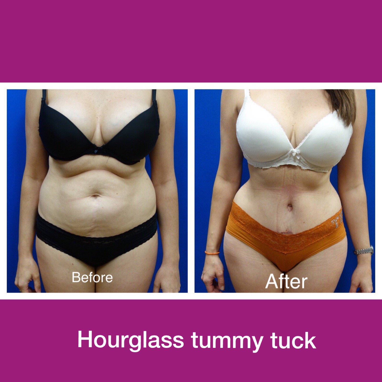 hourglass body with tummy