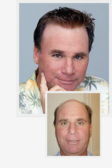 Breakthrough Derma Lens Technology Simulates Human Scalp Newswire