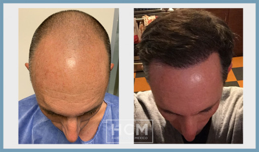 Hair Center Mexico in Tijuana: Top Destination for an FUE Hair Transplant