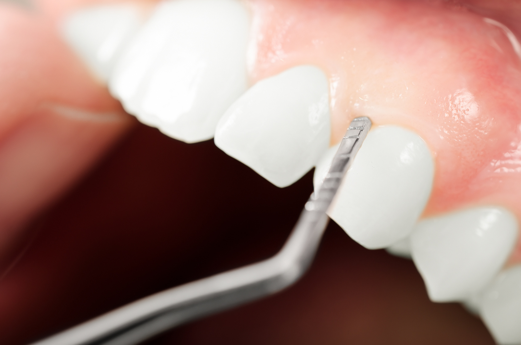 Does Delta Dental Cover Pinhole Surgery?