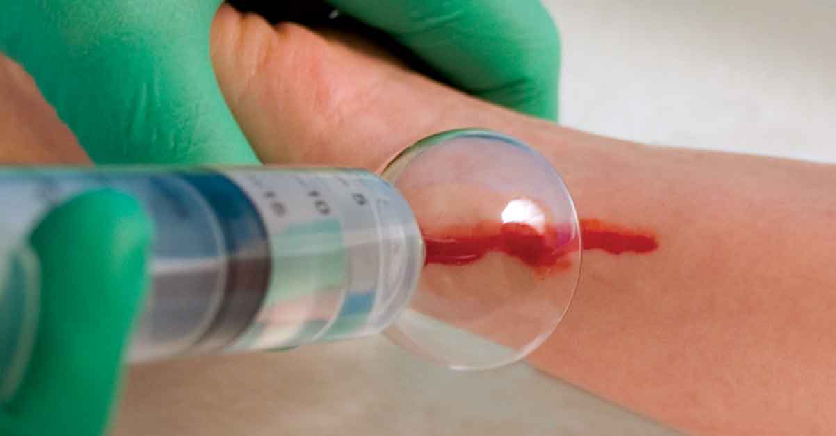 Are irrigation splash guards contributing to wound contamination