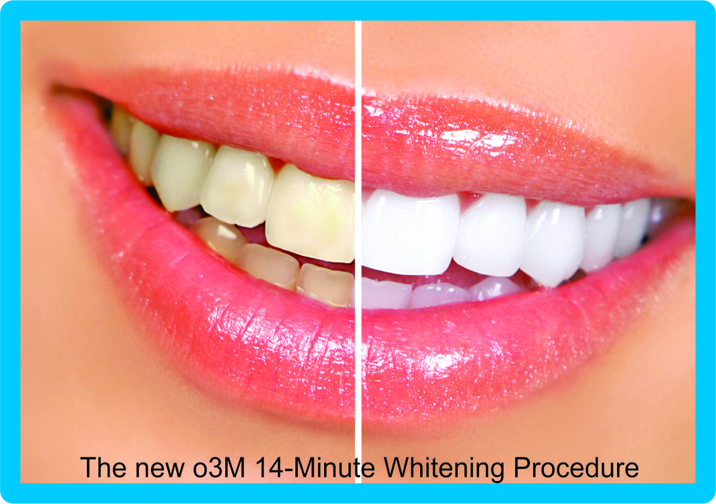 teeth whitening davinci cosmetic major newswire breakthrough apr release press