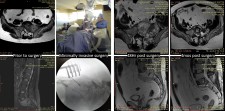 Microwave ablation therapy of sacral plasmacytoma