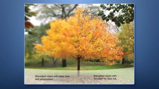 Lehigh Valley Center For Sight Offers AcrySof IQ Toric Lenses-610-628-0545