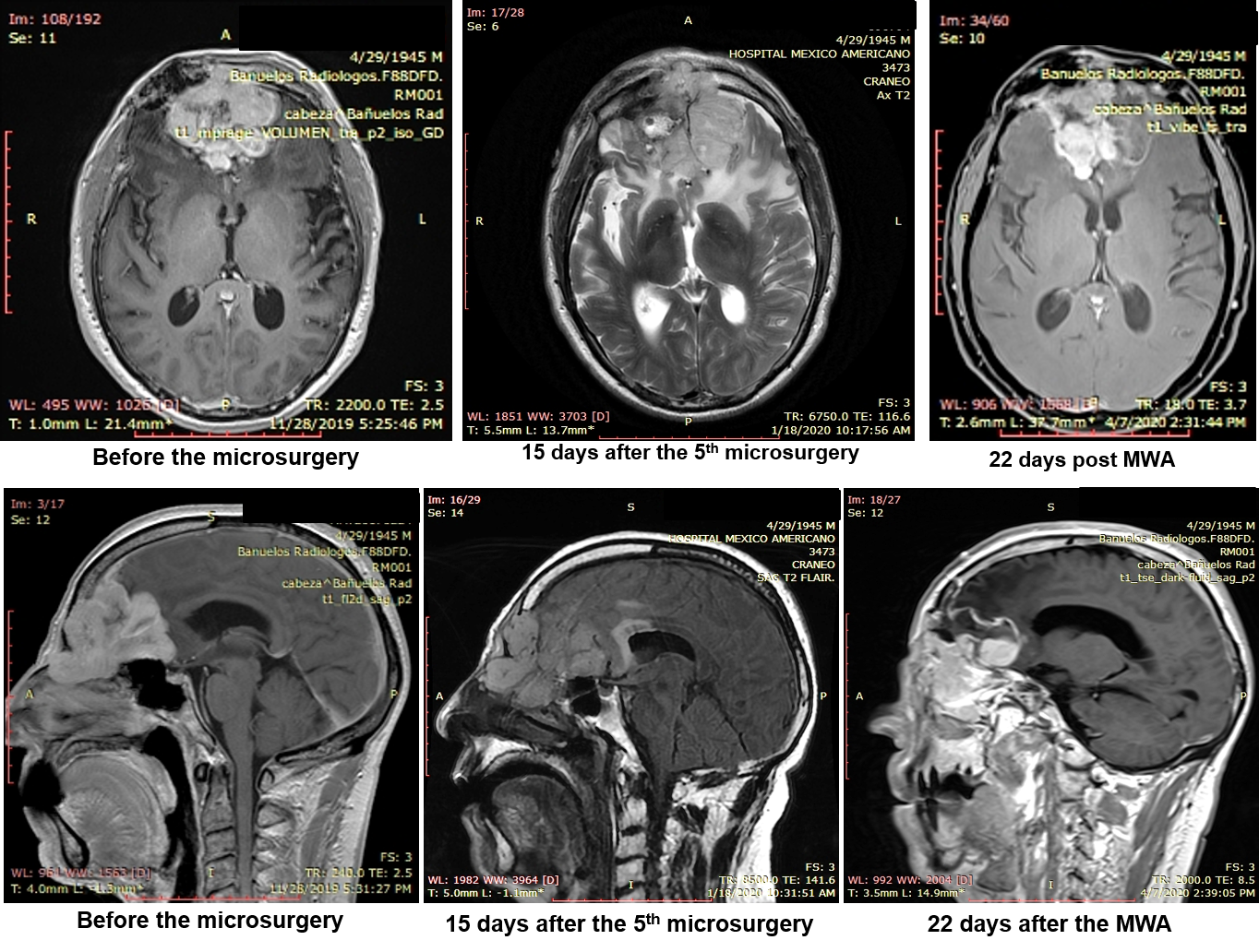 MedWaves AveCure® Microwave Ablation System Used to Successfully Treat