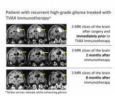 Patient with recurrent high-grade glioma treated with TVAX Immunotherapy