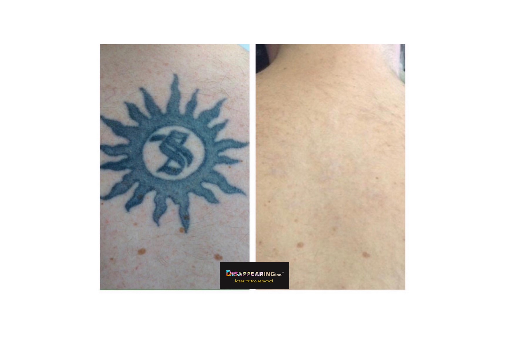 Natural Tattoo Remover Revolutionary Gentle Effective Natural Fading Tattoo  Effective Pattern Removal Effective Tattoo Cleaning - AliExpress