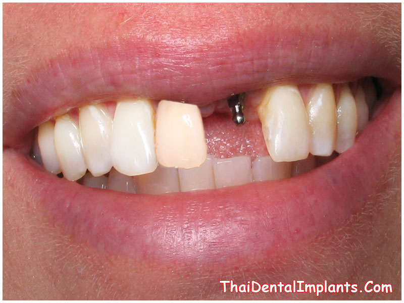 Thai Dental Implants Announces Special Implant Packages in Bangkok