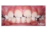 A.L. After