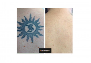 DISAPPEARING inc. Laser Tattoo Removal