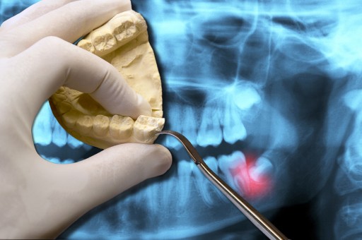 Wisdom Tooth Extraction and Healing: Suggestions From the Sacramento Dentistry Group