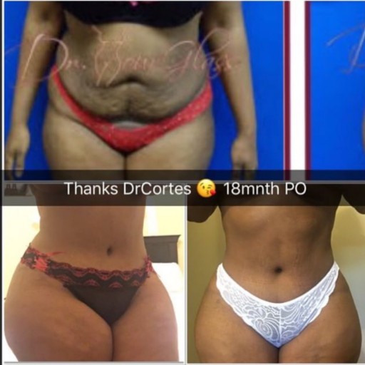 Hourglass Tummy Tuck: The Next Generation in Body Contouring