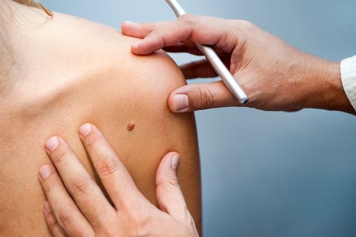 Massage Therapists Can Play an Important Role in Early Skin Cancer Detection