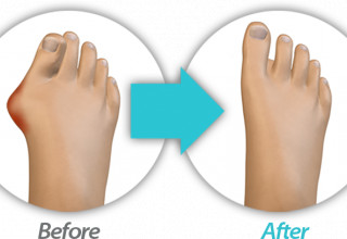 Before and After Bunion Surgery