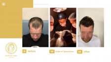 Hair Transplant Before and After Turkey - MedArt Hair Transplant Clinic
