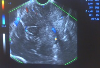 Ultrasound image of microwave treatment