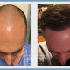 Hair Center Mexico in Tijuana: Top Destination for an FUE Hair Transplant