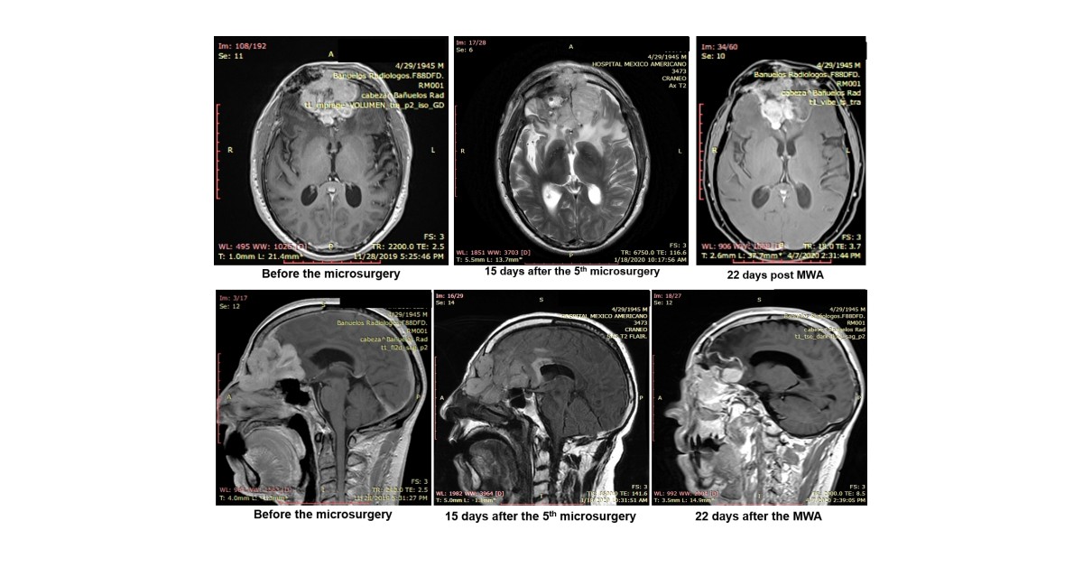 MedWaves AveCure® Microwave Ablation System Used to Successfully Treat Recurrent Brain Tumor