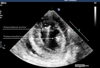 Short axis view of the heart with Vesalius anchors