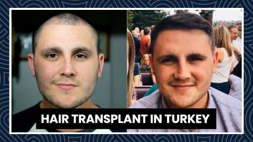 The BBC Visits Smile Hair Clinic in Turkey to Document a Hair Transplant Journey