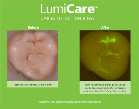 Caries illuminated with LumiCare™ Caries Detection Rinse