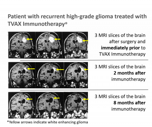 TVAX Biomedical Announces Receipt of  Million FDA Orphan Products Grant for Glioblastoma Study