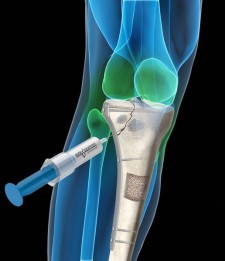 Injectable Bone Graft