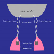 Schematic of the experimental setup. Vesalius anchors are deployed into opposing papillary muscles.