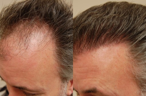San Francisco Bay Area Leader in Robotic Hair Transplant, Silicon Valley Hair Institute Announces New Post on Advantages of Modern Hair Restoration