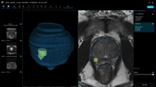 Prostate AI